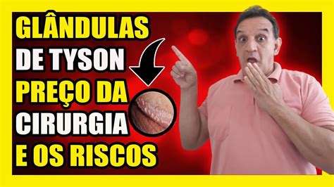 Glândulas de Tyson: o que são e veja se é preciso tratá